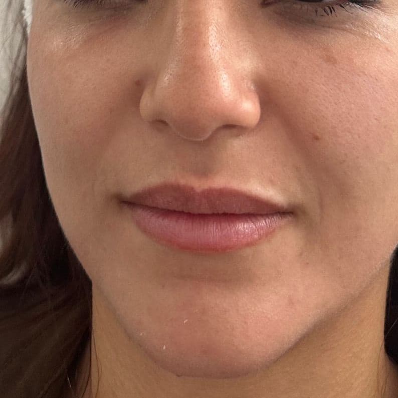 After Neofound EXO treatment 1