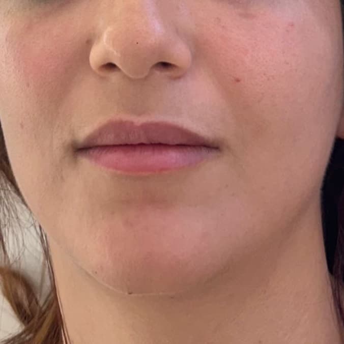 Before Neofound EXO treatment 1