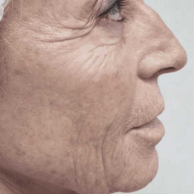 Before Neofound EXO treatment 2