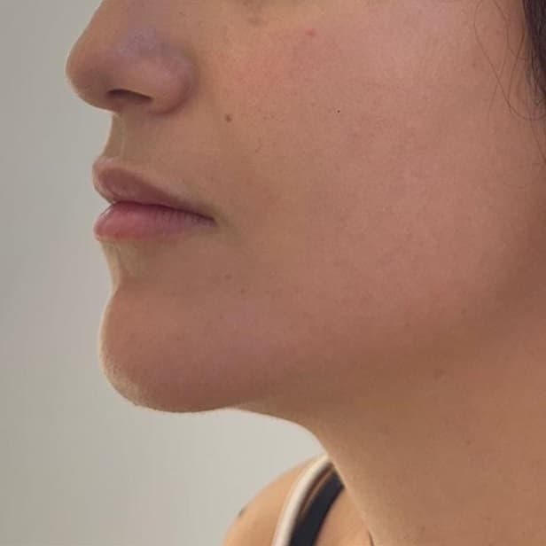 After Neofound EXO treatment 3