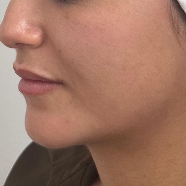 Before Neofound EXO treatment 3