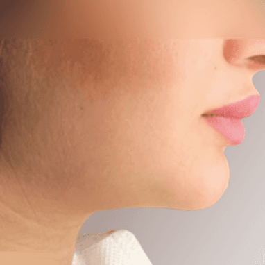 After face treatment 1