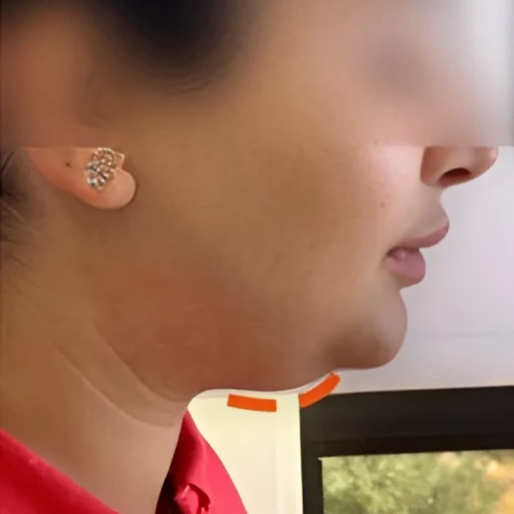 Before body treatment 10