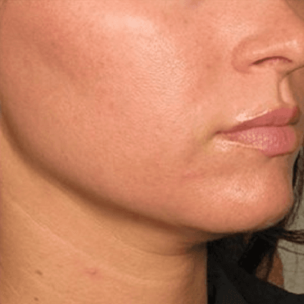 After body treatment 12