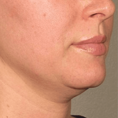 Before body treatment 12