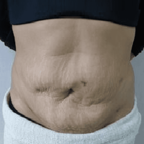 Before body treatment 13