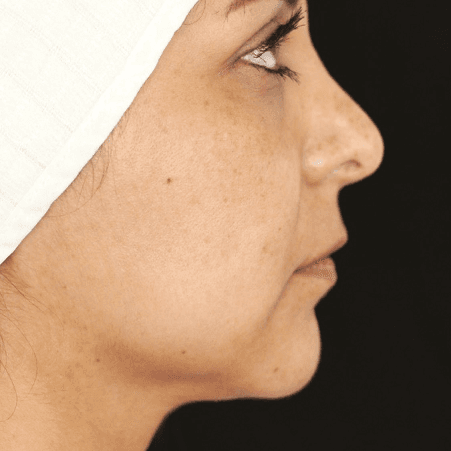 After face treatment 2