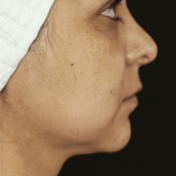 Before face treatment 2