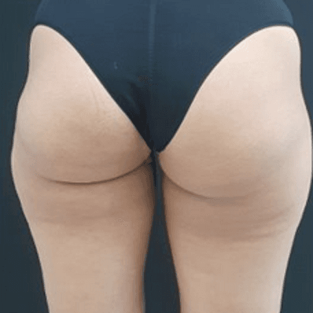 Before body treatment 7