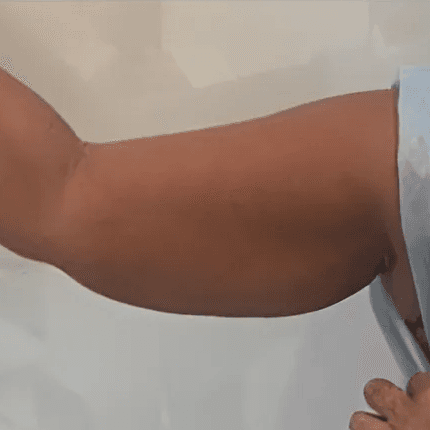 Before body treatment 8