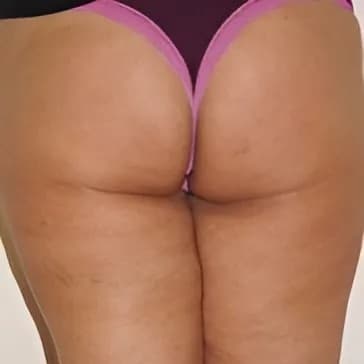 After body treatment 9