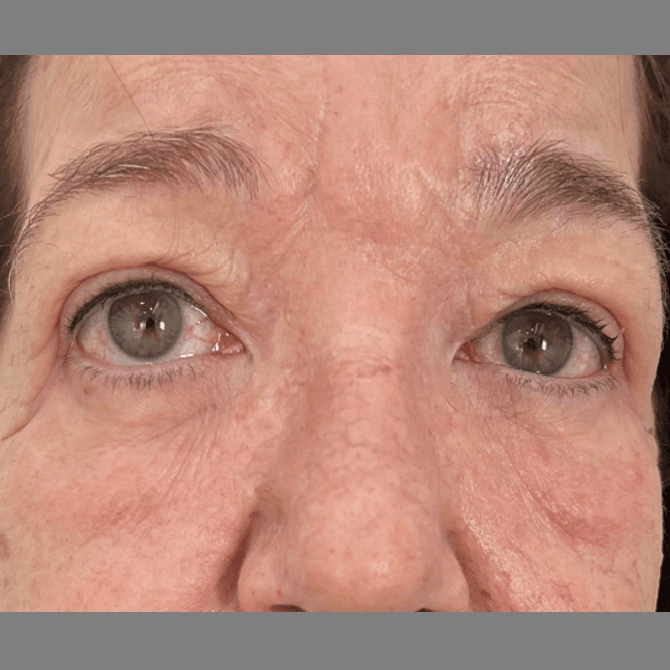 After face treatment 1