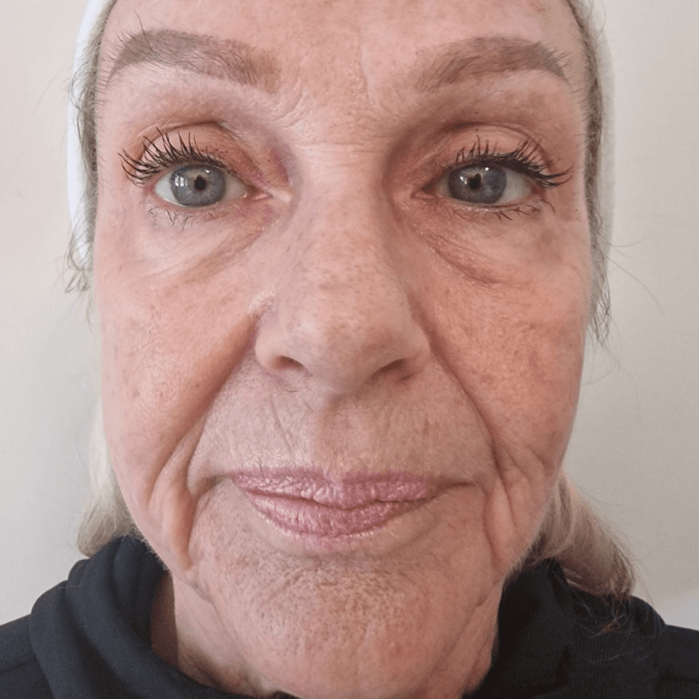 After face treatment 2