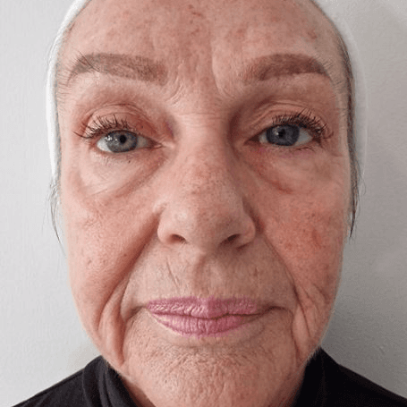 Before face treatment 2