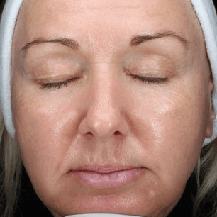 Before body treatment 9